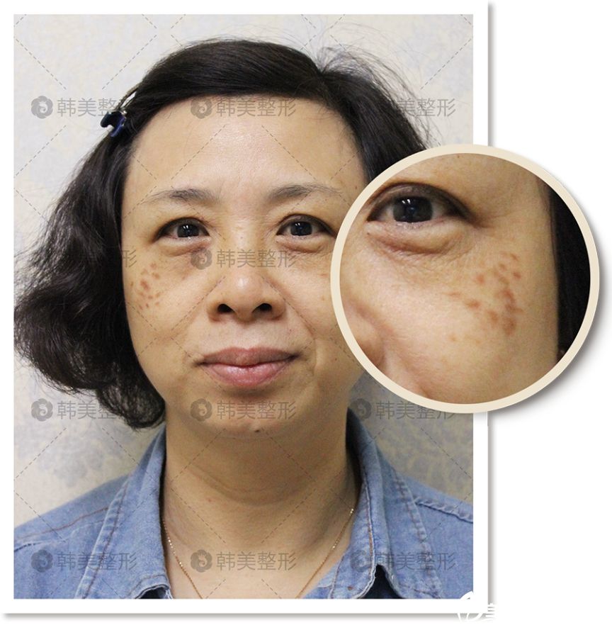 韩美吴彩霞激光去痣真人案例 韩美吴彩霞激光去痣真人案例
