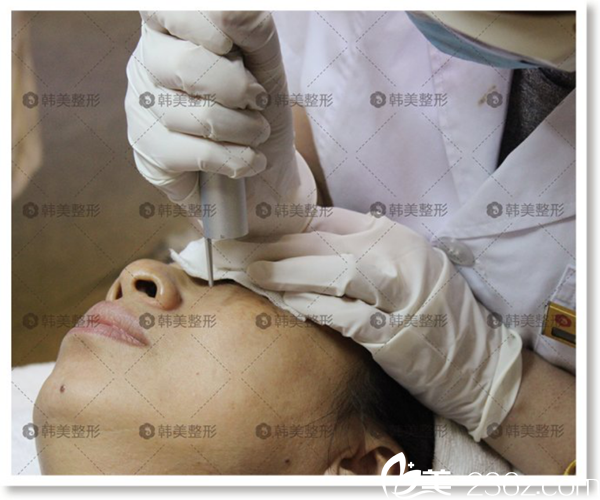 激光去痣 吴彩霞主任正在细心操作 激光去痣 吴彩霞主任正在细心操作