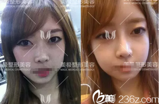 成都美极杨勇达拉斯鼻综合案例