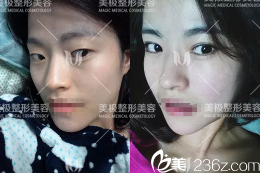 成都美极杨勇眼综合整形对比图