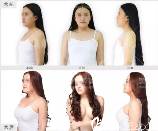 成都美极杨勇3D丰胸整形案例