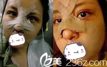 在长春珍妮花23600元做双眼皮和假体隆鼻手术后2天.jpg