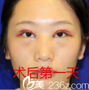 割完双眼皮天恢复情况 割完双眼皮天恢复情况