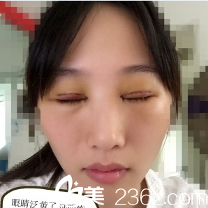 在深圳米兰柏羽做完双眼皮第二天闭眼效果 在深圳米兰柏羽做完双眼皮第二天闭眼效果