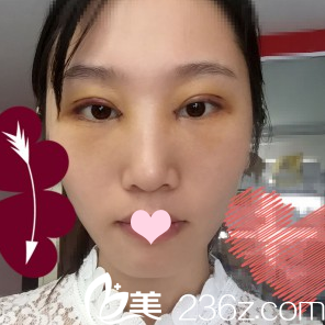 双眼皮术后3天正面自拍 双眼皮术后3天正面自拍