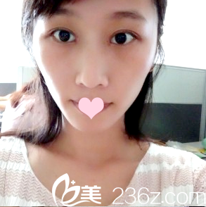 找朱武根主任做双眼皮第7天 找朱武根主任做双眼皮第7天