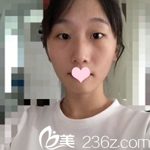 双眼皮术前照 双眼皮术前照