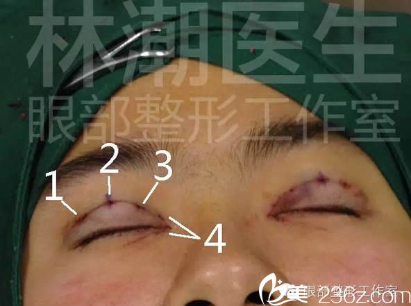 韩式微创三点术式双眼皮手术过程