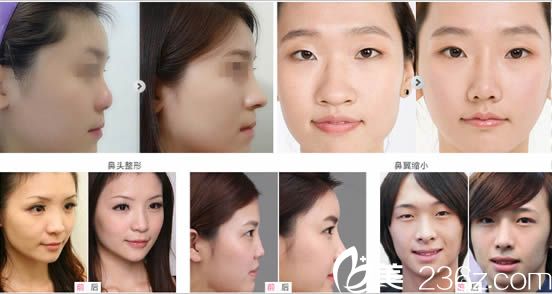 综合隆鼻案例_<!--<i data=20240703-sp></i>-->明