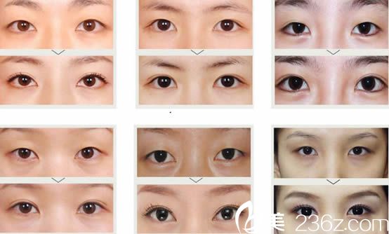 YC媚眼术双眼皮案例_<!--<i data=20240703-sp></i>-->明院长