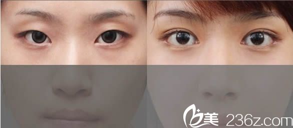 双眼皮案例效果图