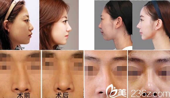 假体隆鼻和歪鼻矫正前后对比案例