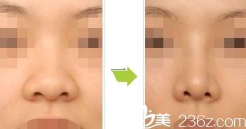 鼻部整形前后对比