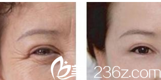 北京煤医整形眼部除皱<span style= 北京煤医整形眼部除皱<span style=