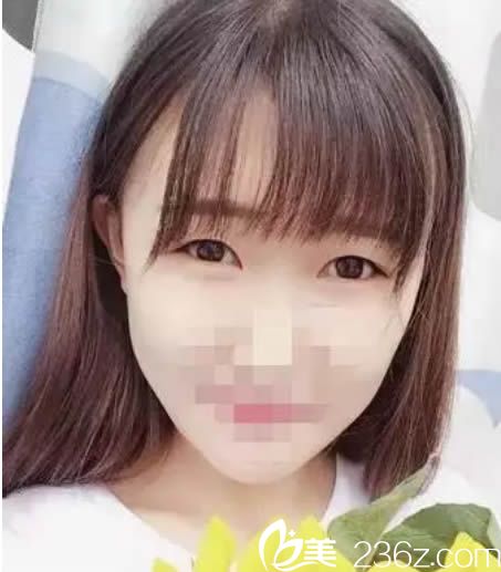 做双眼皮术前的样子 做双眼皮术前的样子