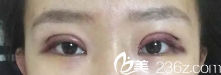 刚做完全切双眼皮即刻的照片 刚做完全切双眼皮即刻的照片