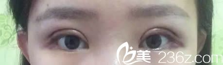 切开双眼皮术后第3天恢复效果 切开双眼皮术后第3天恢复效果
