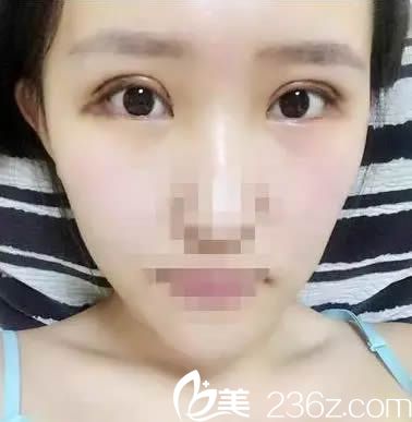 全切双眼皮7天拆线后的美照 全切双眼皮7天拆线后的美照