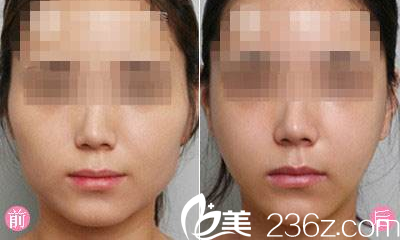 大同清木整形姜际珠瘦脸案例 大同清木整形姜际珠瘦脸案例