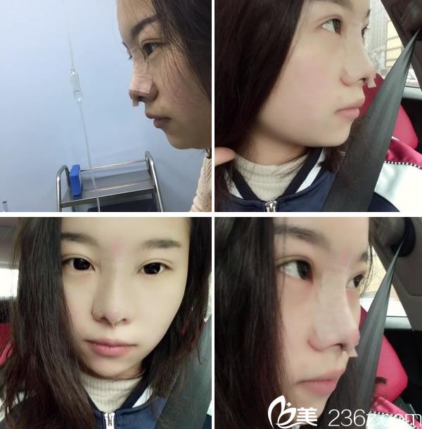 杭州东方做鼻子手术即刻照片