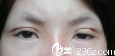 双眼皮手术失败