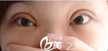 哪些双眼皮需要修复