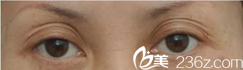 双眼皮修复手术难吗