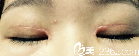 双眼皮手术的疤痕程度影响修复
