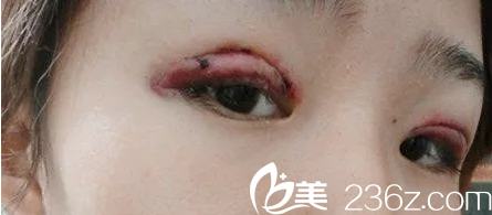 什么样的双眼皮算失败