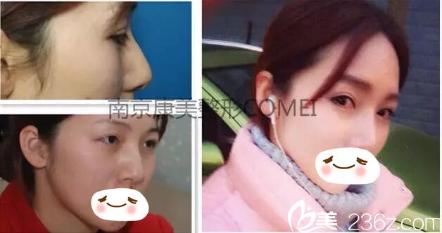 南京康美眼鼻整形术前术后对比案例
