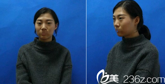 成都皇家美极整形医院刘洁线雕双眼皮术前 成都皇家美极整形医院刘洁线雕双眼皮术前