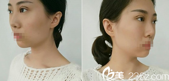 成都美极刘洁线雕双眼皮术后1天恢复效果 成都美极刘洁线雕双眼皮术后1天恢复效果