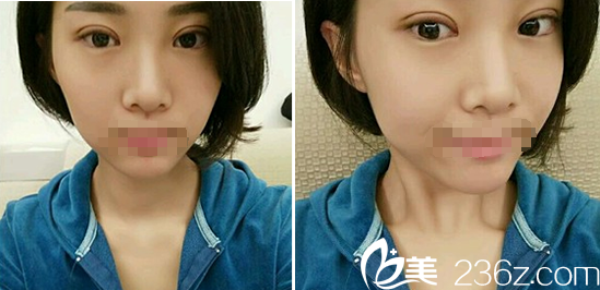 成都皇家美极刘洁埋线双眼皮一周 成都皇家美极刘洁埋线双眼皮一周