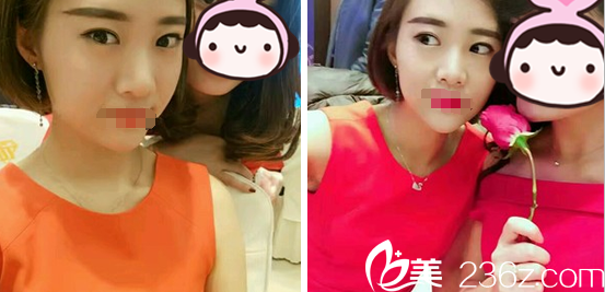 成美极刘洁双眼皮术后10天化妆效果 成美极刘洁双眼皮术后10天化妆效果