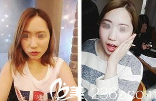 大同清木隆鼻案例术前 大同清木隆鼻案例术前