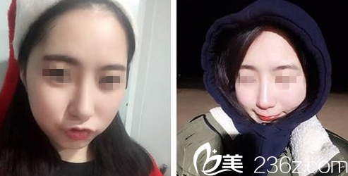 大同清木鼻综合整形术后5个月图 大同清木鼻综合整形术后5个月图