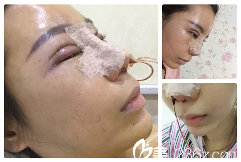 做完双眼皮和隆鼻术后即刻效果 做完双眼皮和隆鼻术后即刻效果