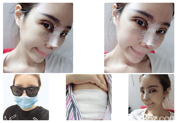 在佛山梦露医院做完双眼皮和隆鼻三天效果 在佛山梦露医院做完双眼皮和隆鼻三天效果