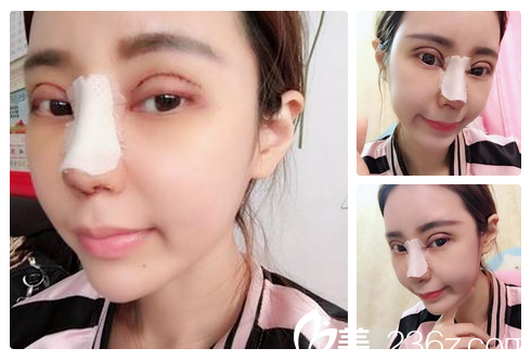 佛山梦露医院游万福双眼皮隆鼻案例恢复期照片 佛山梦露医院游万福双眼皮隆鼻案例恢复期照片