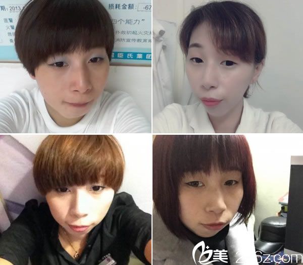 从小到大的单眼皮照片