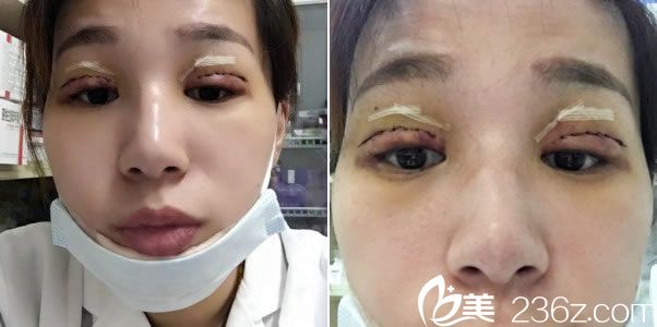 杭州瑞丽全切双眼皮第3天恢复图
