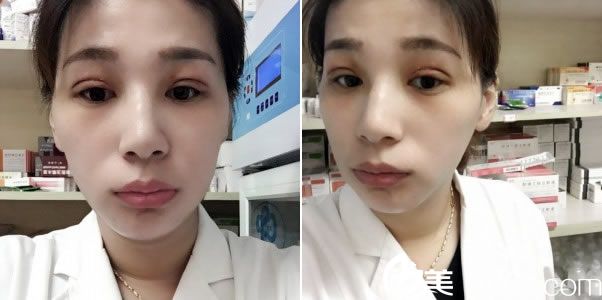 全切双眼皮手术拆线的照片