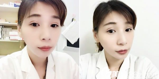 杭州瑞丽做双眼皮14天<span style=