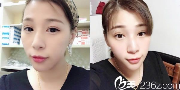 全切双眼皮30天的恢复<span style=