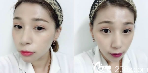 做双眼皮50天的带妆照片