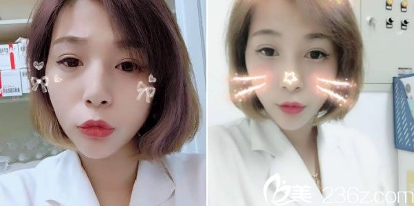 做完双眼皮90天<span style=