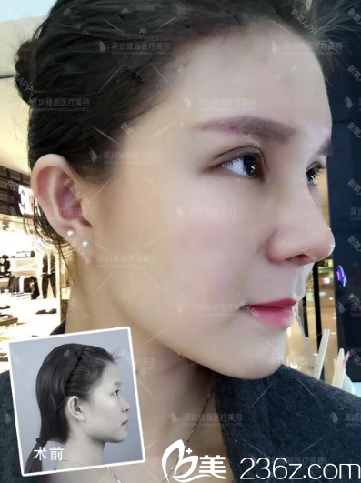 双眼皮隆鼻前后对比照片 双眼皮隆鼻前后对比照片