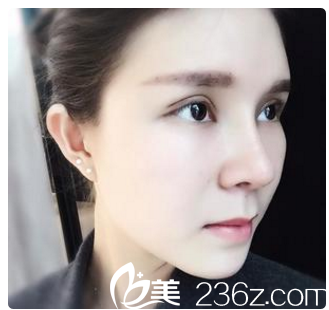 术后侧面自拍 术后侧面自拍