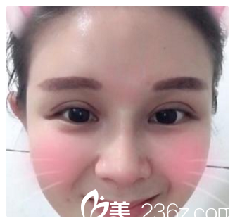 双眼皮开内眼角第九天<span style= 双眼皮开内眼角第九天<span style=