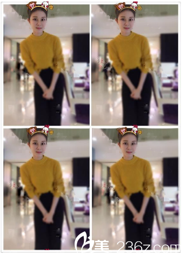 双眼皮隆鼻术后一个月自拍 双眼皮隆鼻术后一个月自拍